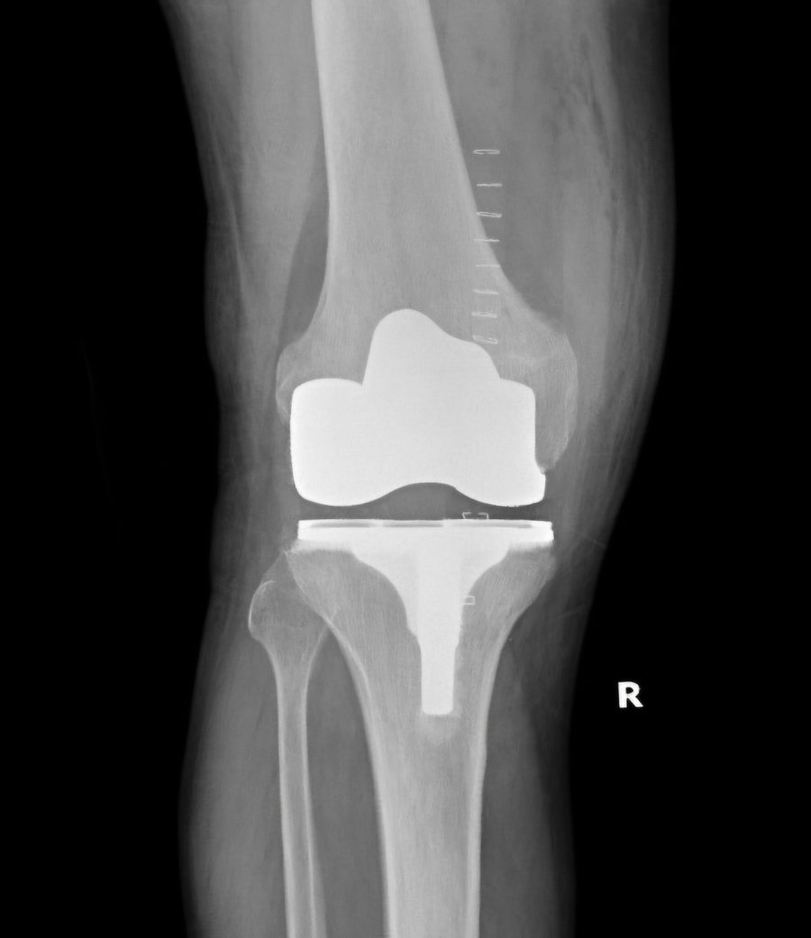 Post-operative AP radiograph of a total knee arthroplasty