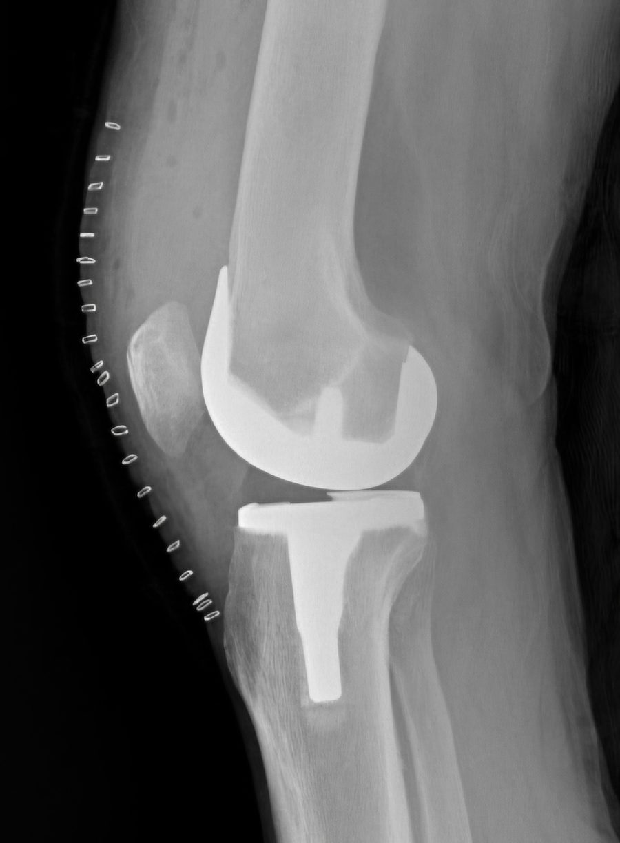Post-operative lateral radiograph of a total knee arthroplasty